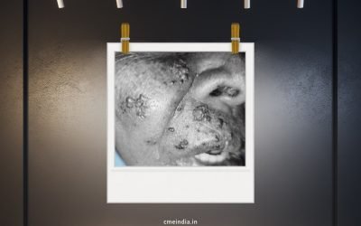 Uncommon presentation of the herpes zoster (shingles) along the maxillary division (V2) of the trigeminal nerve in a controlled T2DM