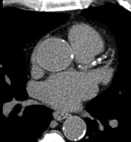 What should I do with a CAC score of 400in my Asymptomatic patient?