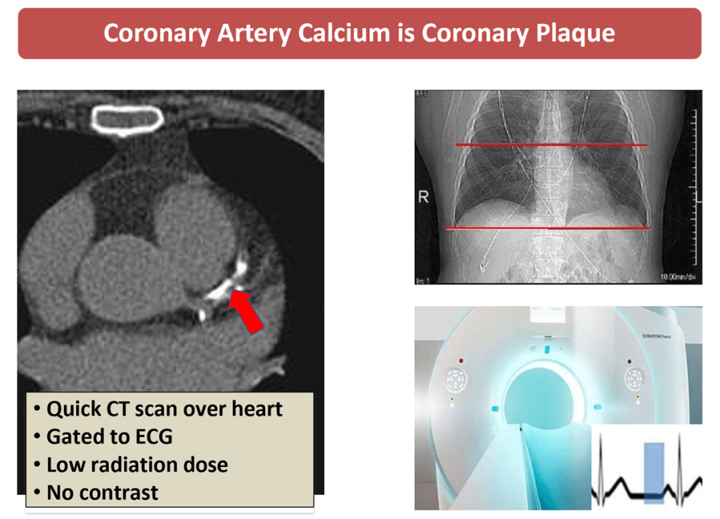 What should I do with a CAC score of 400in my Asymptomatic patient?