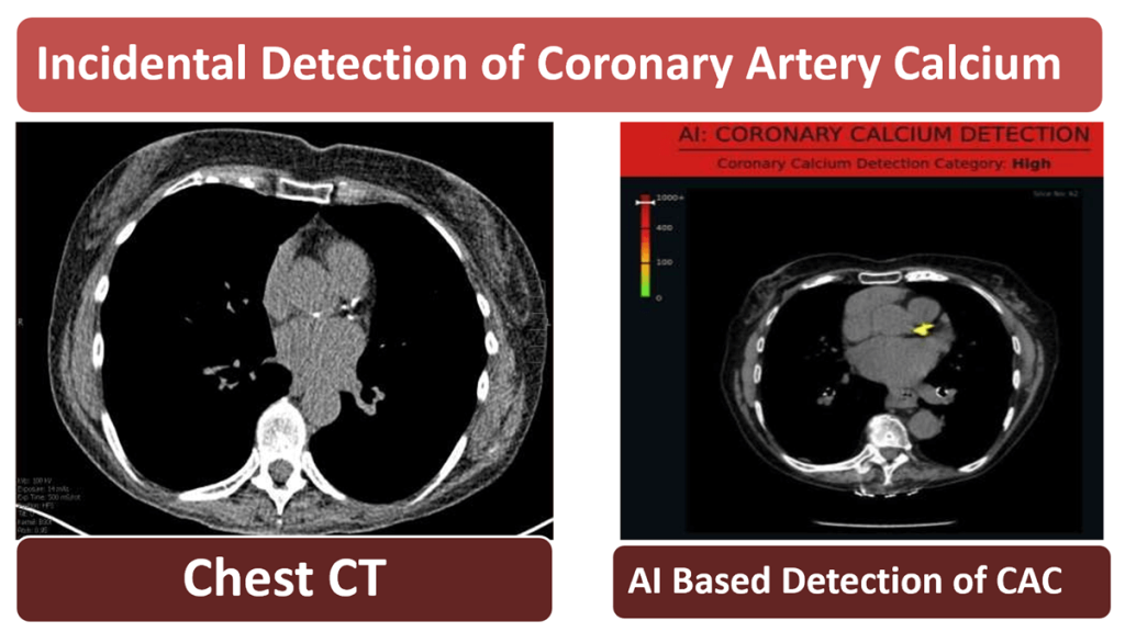 What should I do with a CAC score of 400in my Asymptomatic patient?