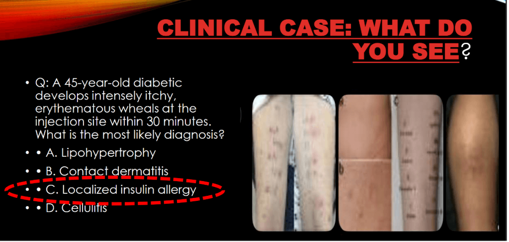 Allergy in Diabetes - What Physicians Must Know?