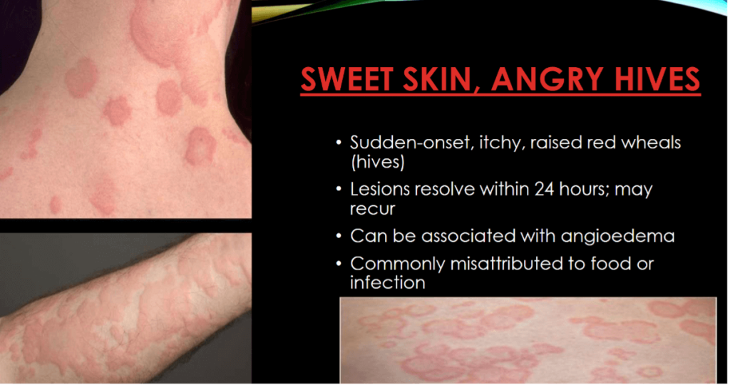 Allergy in Diabetes - What Physicians Must Know?