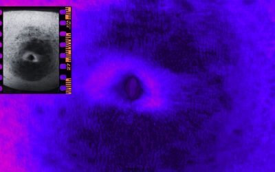 Unusual Periumbilical Hyperpigmentation in a Diabetic Patient
