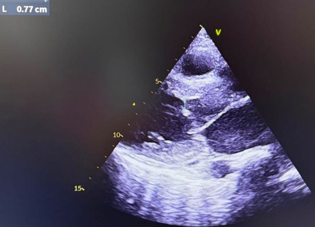Progressive Exertional Dyspnea in a Middle-Aged Woman Case