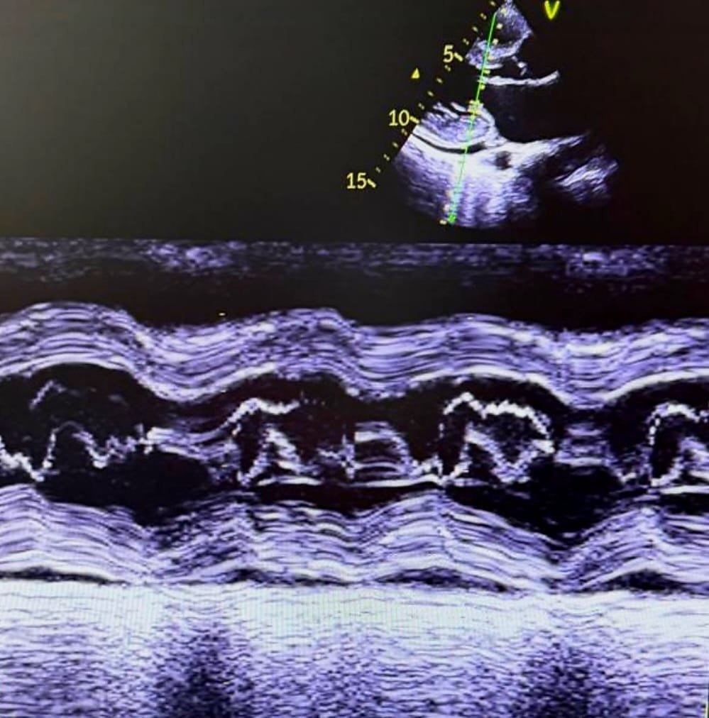 Progressive Exertional Dyspnea in a Middle-Aged Woman Case