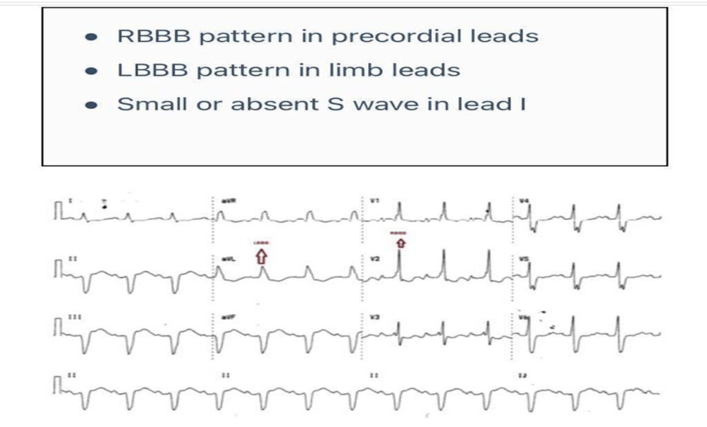 When the ECG Whispers: Hidden Cardiac Emergencies in Diabetes Unmasked