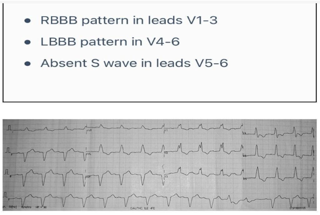 When the ECG Whispers: Hidden Cardiac Emergencies in Diabetes Unmasked