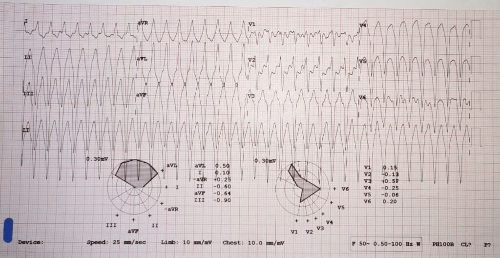 When the ECG Whispers: Hidden Cardiac Emergencies in Diabetes Unmasked
