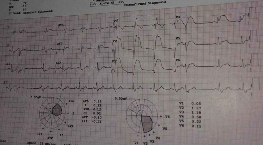 When the ECG Whispers: Hidden Cardiac Emergencies in Diabetes Unmasked