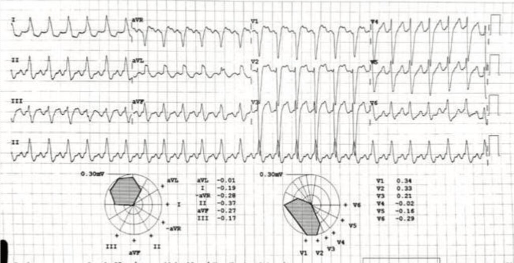 When the ECG Whispers: Hidden Cardiac Emergencies in Diabetes Unmasked