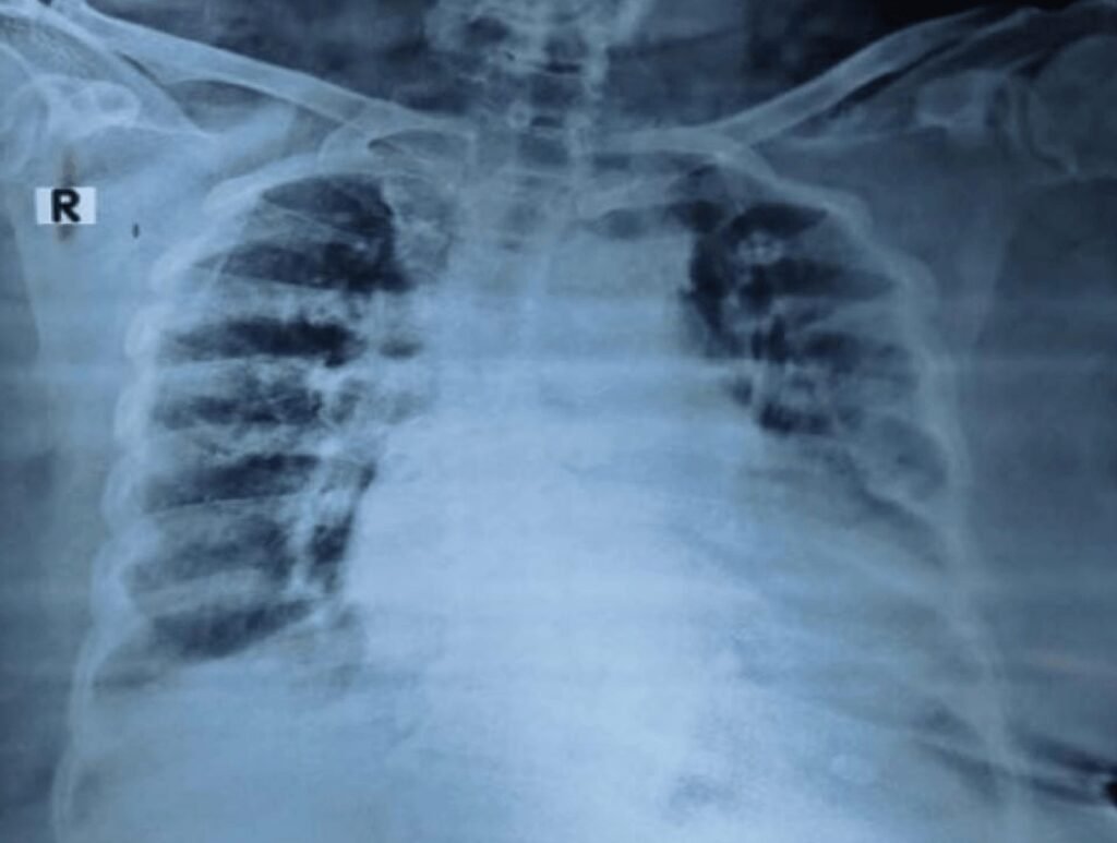 When the ECG Whispers: Hidden Cardiac Emergencies in Diabetes Unmasked