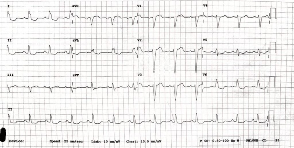 When the ECG Whispers: Hidden Cardiac Emergencies in Diabetes Unmasked