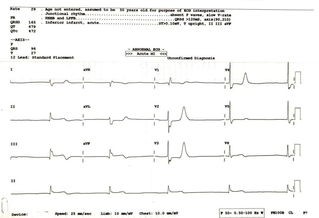When the ECG Whispers: Hidden Cardiac Emergencies in Diabetes Unmasked