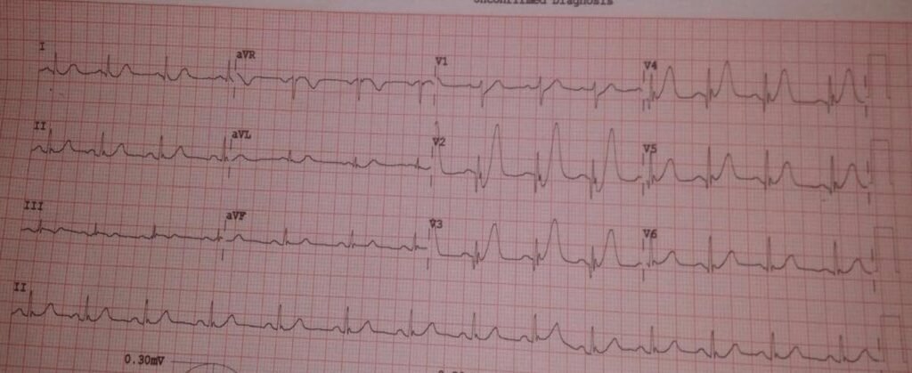 When the ECG Whispers: Hidden Cardiac Emergencies in Diabetes Unmasked
