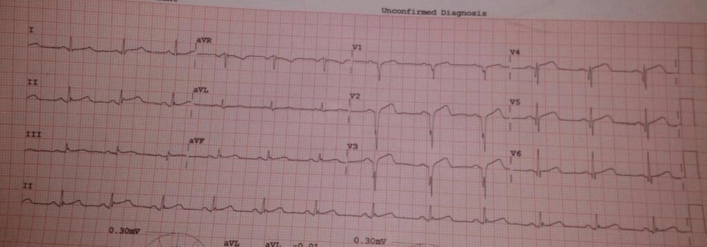 When the ECG Whispers: Hidden Cardiac Emergencies in Diabetes Unmasked