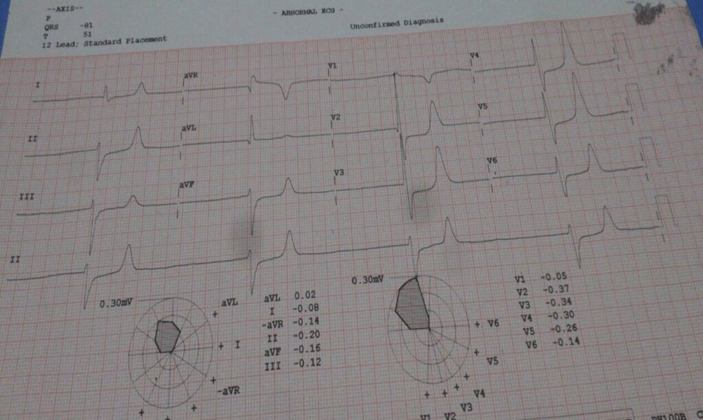 When the ECG Whispers: Hidden Cardiac Emergencies in Diabetes Unmasked
