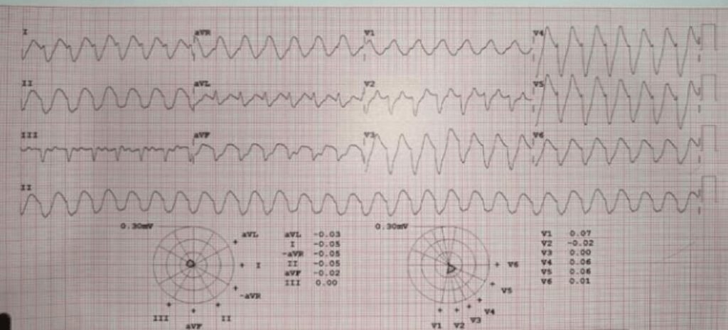 When the ECG Whispers: Hidden Cardiac Emergencies in Diabetes Unmasked
