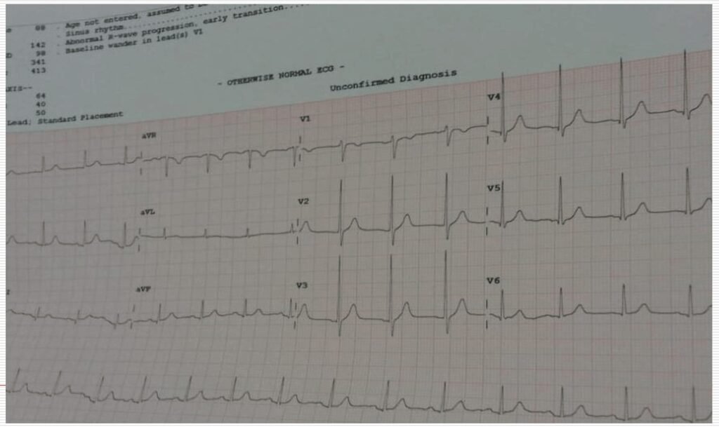 When the ECG Whispers: Hidden Cardiac Emergencies in Diabetes Unmasked