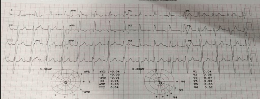 When the ECG Whispers: Hidden Cardiac Emergencies in Diabetes Unmasked